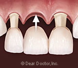 AFixedBridgeRemainsanEffectiveOptionforToothReplacement