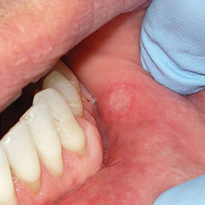 KeepaLookoutforTheseSoftTissueConditionsintheMouth