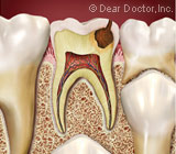 SavingaDiseasedPrimaryToothCouldBenefitFutureOralHealth