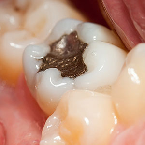 EvenwithMercuryDentalAmalgamisaSafeChoiceforToothFilling