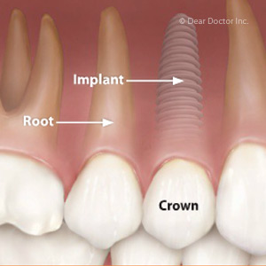 LookattheLong-TermCostsWhenConsideringDentalImplants