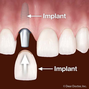 3PossibleTimingScenariosforGettingYourNewImplant