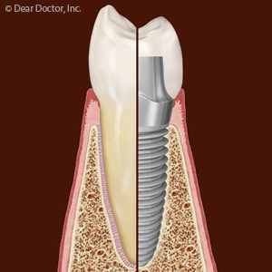 TheManyAdvantagesofDentalImplants