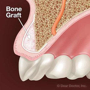 WemayNeedtoBuilduptheBoneinYourJawbeforeImplants