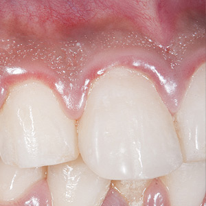 CertainFactorsMayRaiseYourRiskandtheIntensityofGumDisease