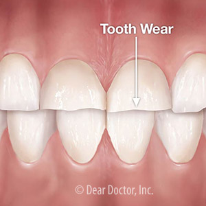 3DentalProblemsThatCouldBeCausingExcessiveDentalWear