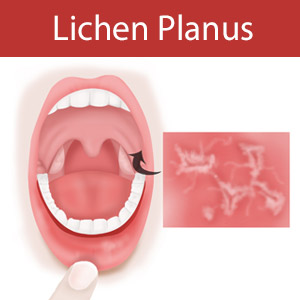 AlthoughItSoundsExoticThisMouthSoreIsntaBigConcern