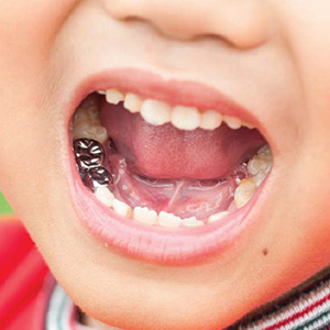 AStainlessSteelCrownCouldHelpaStrugglingPrimaryMolarLastLonger