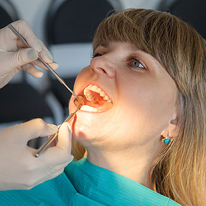 MinimallyInvasiveDentistryANewApproachtoPreventingandTreatingDecay