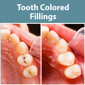 4AdvantagestoUsingCompositeResinsforRestoringTeeth