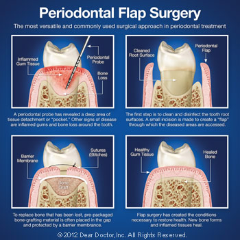 Periodontal flap surgery.
