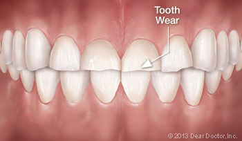 Tooth wear.