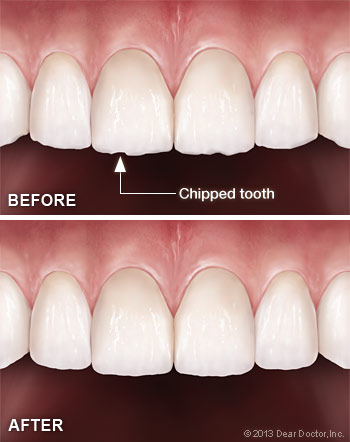 Tooth contouring and reshaping.