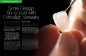 Smile Design Enhanced with Porcelain Veneers